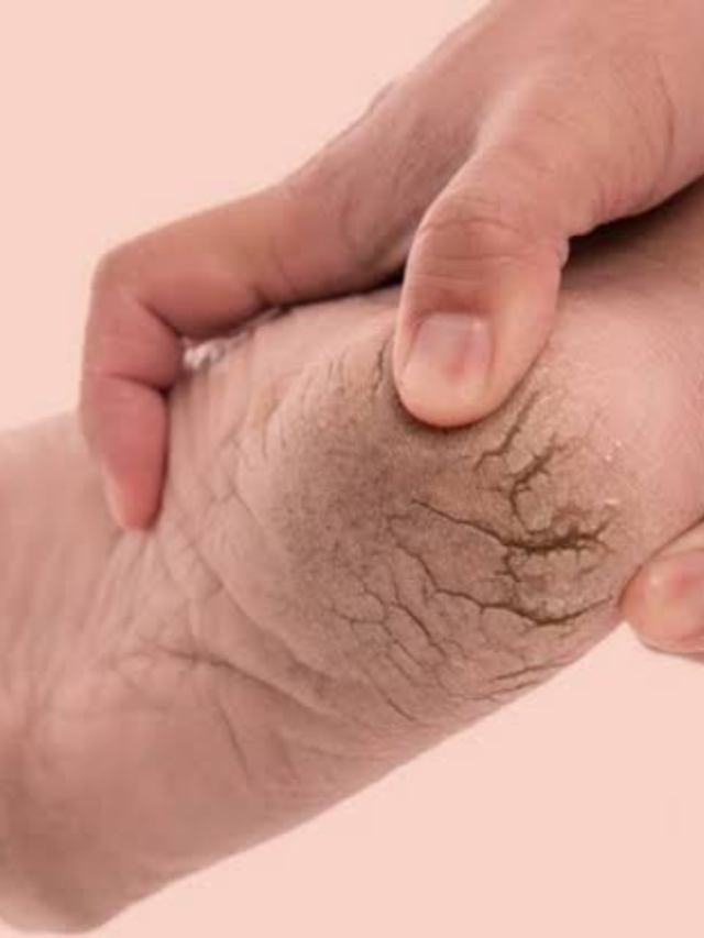 एड़ियों को फटने से बचाने के लिए अपनाए ये टिप्स